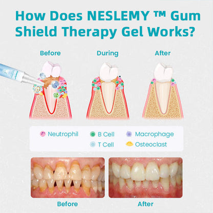 Last Day Promotion 80% OFF-NESLEMY™ Gum Shield Therapy Gel
